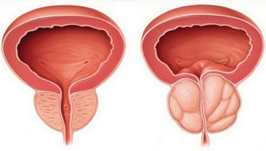 zdrava i upaljena prostata s prostatitisom