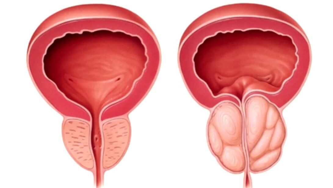 zdrave i bolesne prostate