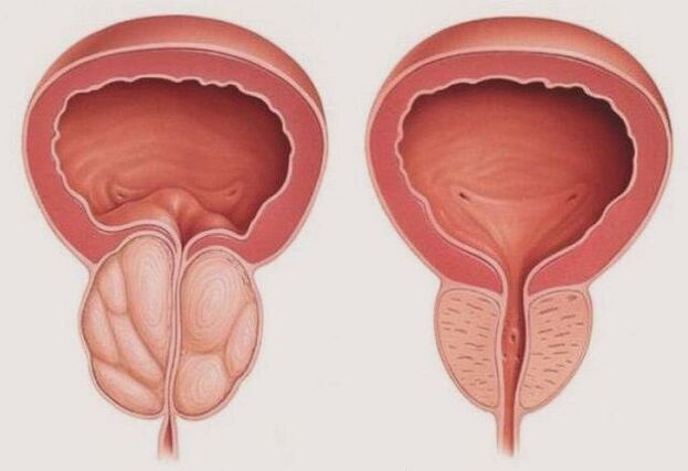 zdrava i upaljena prostata s prostatitisom