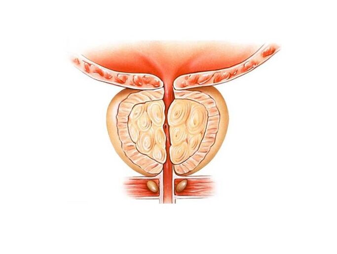 upala prostate